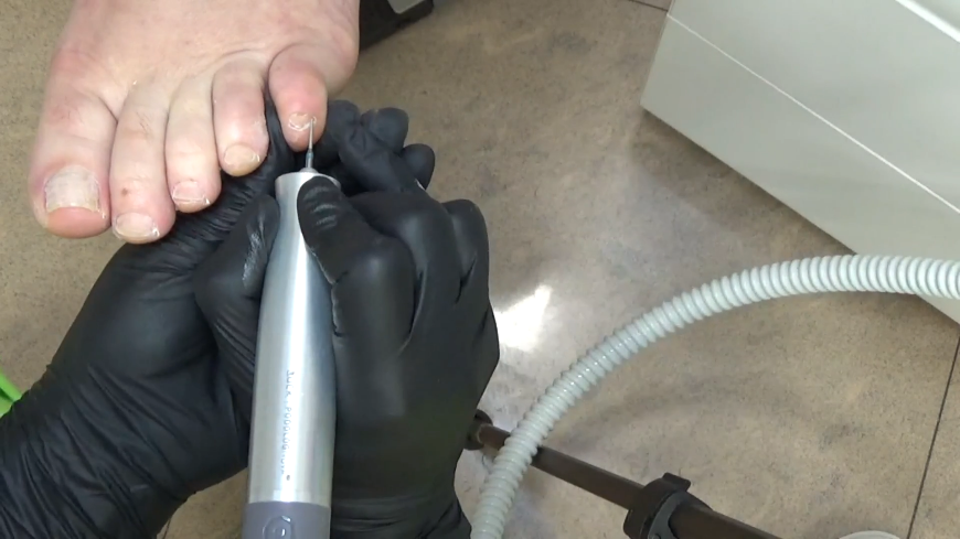 Апаратен педикюр I част